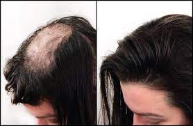 If You Re Losing Your Hair Or Have Thinning Hair Please Contact Us We Can Help You And Make You Fe Wigs For Cancer Patients Thinning Hair Loss Hair Extentions