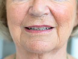 In the past, some people believed that alcohol consumption could lead to the condition. Facial Flushing And Carcinoid Syndrome