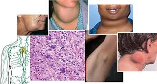 Medical collage: swollen lymph nodes, lymphatic system diagram, and lymphoma tissue microscopy