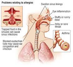 Seasonal Allergies Feel Like They Are Getting Worse Every Year Yes They Are Health Suite 110 Direct Primary Care