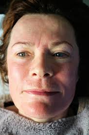 Medical Micro Needling under the Spotlight