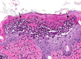 Image result for Pustule