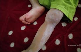 Bagaimanakah ciri ciri penyakit kencing nanah sudah mau sembuh. Cara Merawat Anak Terkena Hfmd
