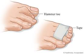 Image result for Hammer toe