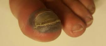 Your big toe is likely going to be a bigger problem than my small toe. Dropped Something Heavy On Your Big Toe Is It Fractured Sprained Or Broken Belmont Anderson Dpm Las Vegas Podiatrist Foot Doctor