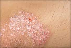 A chronic skin disease characterized by circumscribed red patches covered with white scales. Psoriasis Symptoms 5 Signs Symptoms Of Psoriasis