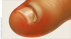 Image result for Paronychia feet