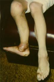Sjögren's syndrome is one such disease, and it is associated with symptoms including fatigue, myalgia and arthralgia. Hereditary Sensory And Autonomic Neuropathies Types Ii Iii And Iv Orphanet Journal Of Rare Diseases Full Text