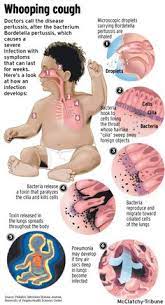 The united states began widespread vaccinations in the 1940s, which nearly eradicated the disease. Whooping Cough