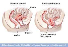 Sementara siswa di beijing, shanghai, guangdong, dan hubei masih menunggu untuk kembali ke sekolah dan masih tetap belajar secara online. Hannahrayyan Shoppe Tombong Rahim Jatuh Uterus Proplapse Jangan Ambil Mudah