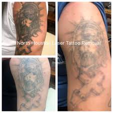 The houston tattoo removal clinic is dedicated to the service we provide to the people of houston. Great Fading Happening Here 281 440 Gone North Houston Laser Tattoo Removal Facebook