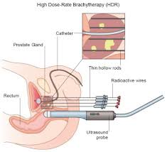 It may grow slowly and it's typically treatable. Brachytherapy About Prostate Cancer
