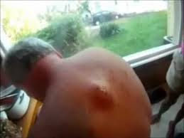 Epic Cyst Pop Tribute Youtube In 2020 Pimple Popping Zits Popping Cysts