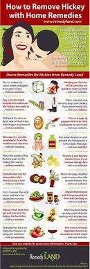 How To Remove Hickey Fast With Home Remedies Remedy Land Home Remedies Remedies How To Remove