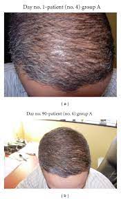 Your doctor will rule out any other reasons which could explain these symptoms before you are treated. Pilot Study Of 15 Patients Receiving A New Treatment Regimen For Androgenic Alopecia The Effects Of Atopy On Aga Abstract Europe Pmc