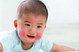 Perlu Tahu, Gejala yang Ditimbulkan Sindrom Cushing