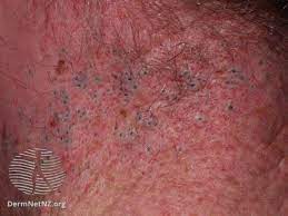 As it cannot be clinically reliably distinguished from more severe forms of skin cancer, keratoacanthomas are usually treated surgically. Comedonal Acne Symptoms Causes Treatment Prevention