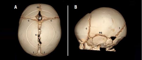 Craniosynostosis:ما دور الدرز الحرشفي في نمو رأس الرضيع؟