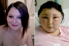 Hair dye horror: Girl's head swells up like a football following severe  reaction to dye