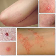 Lift your spirits with funny jokes, trending memes, entertaining gifs, inspiring stories, viral videos, and so much more. Red Bumps On Arms Causes Symptoms And Treatment Natureword