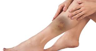 Calf Contusion Symptoms Causes Treatment Rehabiltiation