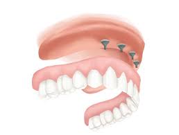 Plans starting under $7 per month Full Mouth Dental Implant Cost Villa Park Il How Much All On 4 Dental Implants 2021 Same Day Handcrafted Smiles