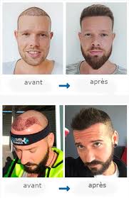 En plus de soins de cheveux, nous proposons également une gamme de soins esthétiques. Greffe De Cheveux Turquie Implant Capillaire Avec Elithair