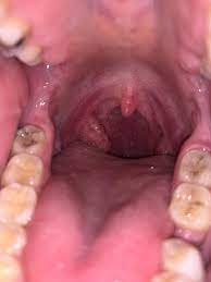 We did not find results for: Is It Normal For My Throat To Look This Way Sexual Health Forums Patient