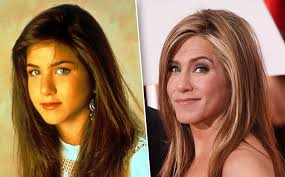 Burnini plastik operatsiya qildirgan mashhurlar