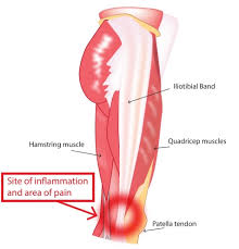 Hyperextended knee is a kind of injury that affects the knee. Knee Exam Stanford Medicine 25 Stanford Medicine