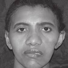 PDF) Giant sialocele following facial trauma