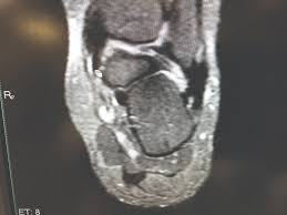 Home » muscles tendons » plantar muscles of the foot. A Closer Look At Imaging Options For Complicated Heel Pain Podiatry Today