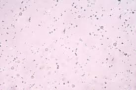 Épidémiologie divers pierre urinaires sont fréquents davantage touchent alentour une personne dessus dix en france. Modere Cristaux D Oxalate De Calcium Dans L Analyse D Urine Banque D Images Et Photos Libres De Droits Image 47187736