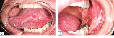 The term oral cancer includes cancer of the mouth (oral cavity) and the back of the mouth (oropharynx). Racgp Common Benign And Malignant Oral Mucosal Disease