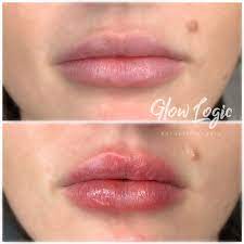 Your trusted lip fillers clinic in london. Pin On Hyaluron Pen Before After