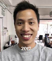 Oh the joy of being able to smile freely and confidently without feeling  self-conscious or insecure! After living with crooked teeth for 15 years, I  learnt to live in denial, telling myself