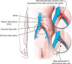 May Thurner Syndrome In Lima Oh Iliac Vein Compression Syndrome