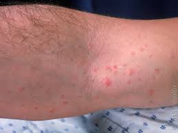 Image result for scabies human bites