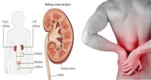 Kidney Stones Are The Precipitates Of Salts That Accumulate Within The Kidney Or The Urinary Tract And Solidify T Kidney Disease Symptoms Kidney Disease Kidney