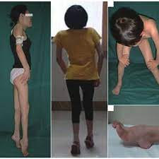 Nord guide to rare disorders. Images Of The Three Patients With Emery Dreifuss Muscular Dystrophy In Download Scientific Diagram