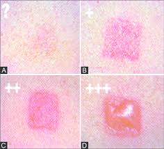 Image result for Patch Testing