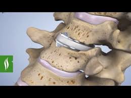 Minimally Invasive Cervical Disc Replacement Laser Spine Institute Cervical Disc Cervical Spinal Surgery
