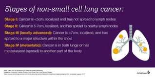 This stage is also called carcinoma in situ, which means cancer in place. this is used to describe a tumor that is only found in the very stage 1: 5 Important Things To Know About Lung Cancer