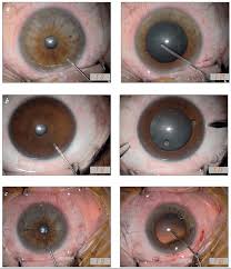 Image result for Mydriatic