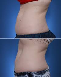 Because of how successful the treatment has been, it has gained a lot of praise and respect in the media. Coolsculpting Before And After Photos
