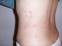 Image result for flea bite