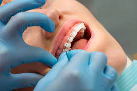 See full list on wikihow.com What Is Braces Wax And How Do You Use It Gentle Dental