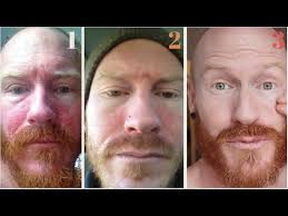 The DIET that saved my SKIN ( 10 years eczema