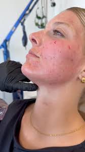 Mehr ist mehr? In der Hautpflege klar ein Mythos! ☝🏼 Die Überpflege der  Haut kann zu (noch mehr) Unreinheiten führen, die dann versucht werden,  durch aggressive und zumeist unpassende Pflege in den