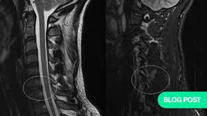 Image result for Subaxial Injury Classification Scale